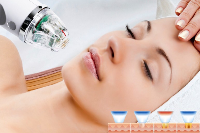 ĐIỀU TRỊ SẸO RỖ VỚI CÔNG NGHỆ RF SIÊU VI ĐIỂM VÀ PRP