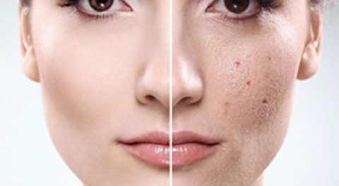 LIỆU PHÁP ĐIỀU TRỊ SẸO RỖ ĐỘT PHÁ MỚI ĐÃ CÓ MẶT TẠI VIỆT NAM