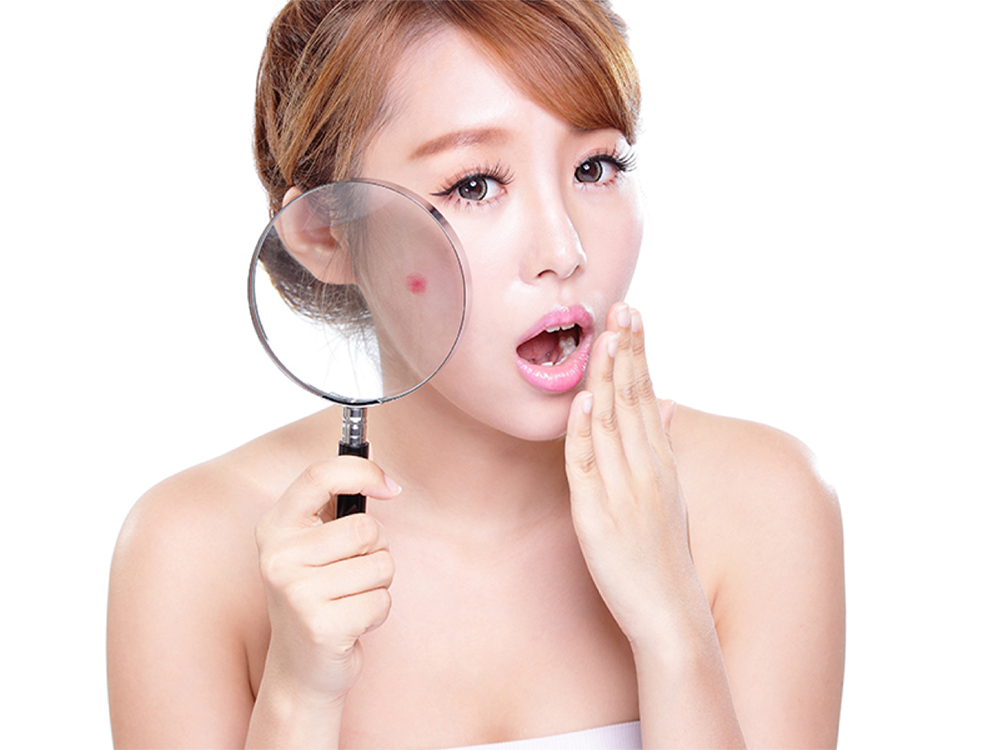 LASER ĐIỀU TRỊ VẾT THÂM SAU MỤN VÀ NGĂN NGỪA SẸO