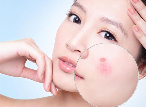 ĐIỀU TRỊ MỤN TRỨNG CÁ BẰNG LIỆU PHÁP LASER FRAXEL