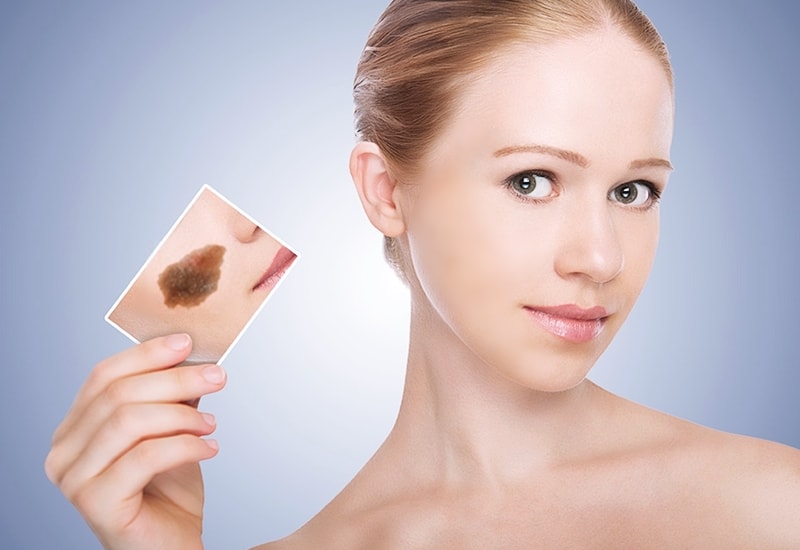XÓA VẾT BỚT BẨM SINH TRÊN DA