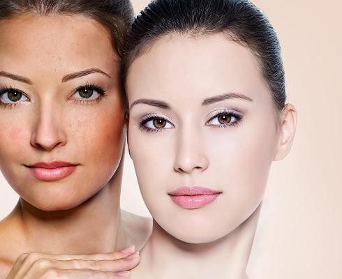 ĐIỀU TRỊ NÁM DA – SẮC TỐ NỘI TIẾT TỐ DA