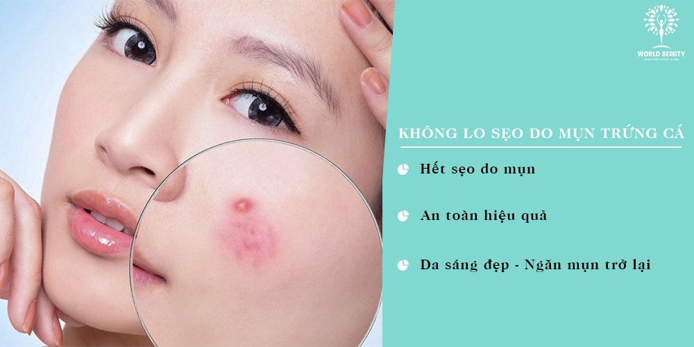 ĐIỀU TRỊ SẸO TỪ MỤN TRỨNG CÁ