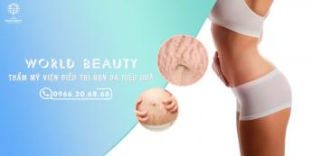 Những bài thuốc trị rạn da bụng sau sinh hiệu quả